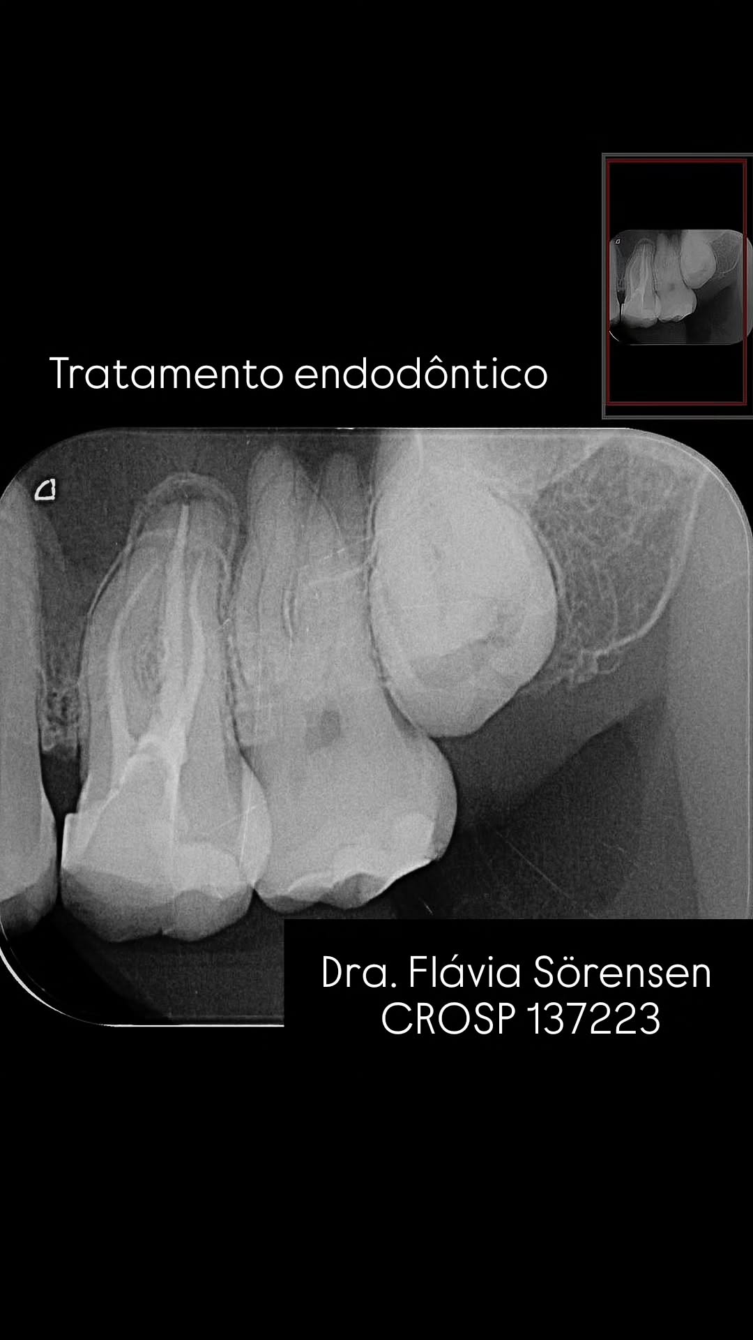 Antes e depois do tratamento de canal